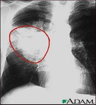 Lung cancer, frontal chest X-ray