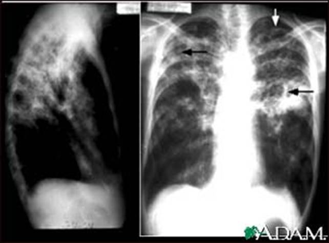 Tuberculosis, advanced - chest X-rays