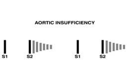 Cardiac Insufficiency