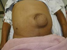 umbilical hernia