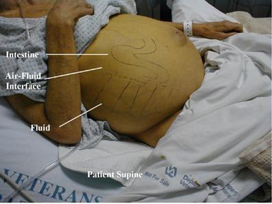 abdomen-ascites2