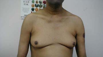 Gynecomastia